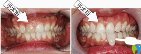 廣州德倫口腔皓齒美白+貼面修復(fù)案例對(duì)比圖
