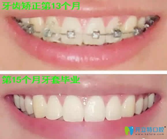 我在天津瑞金口腔做虎牙矯正15個(gè)月照片