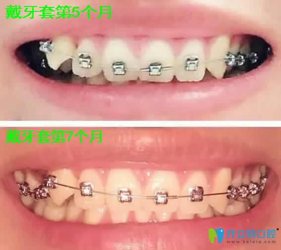 我在天津瑞金口腔做牙齒矯正第3和第7個(gè)月照片