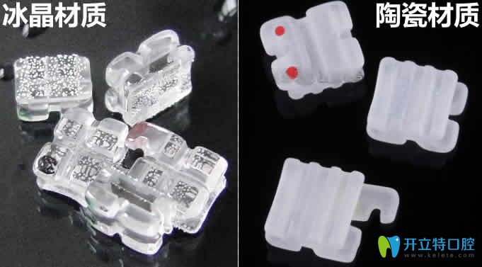冰晶牙套與陶瓷牙套材質區(qū)別圖