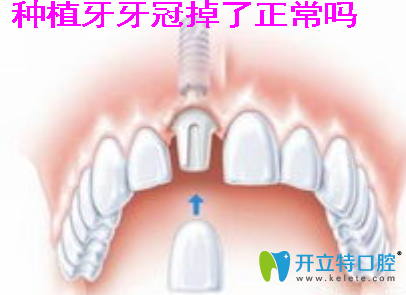種植牙牙冠掉了正常嗎?看種植牙牙冠脫落的原因及如何修復(fù)