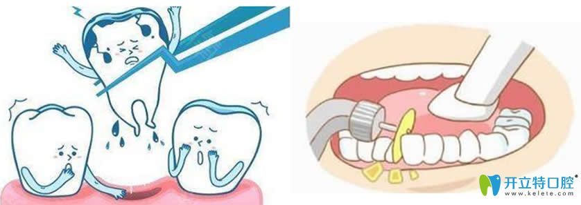 整牙片切和拔牙哪個好？揭秘做的片切正畸后悔死了的原因
