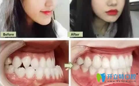 28歲矯正牙齒前后照片