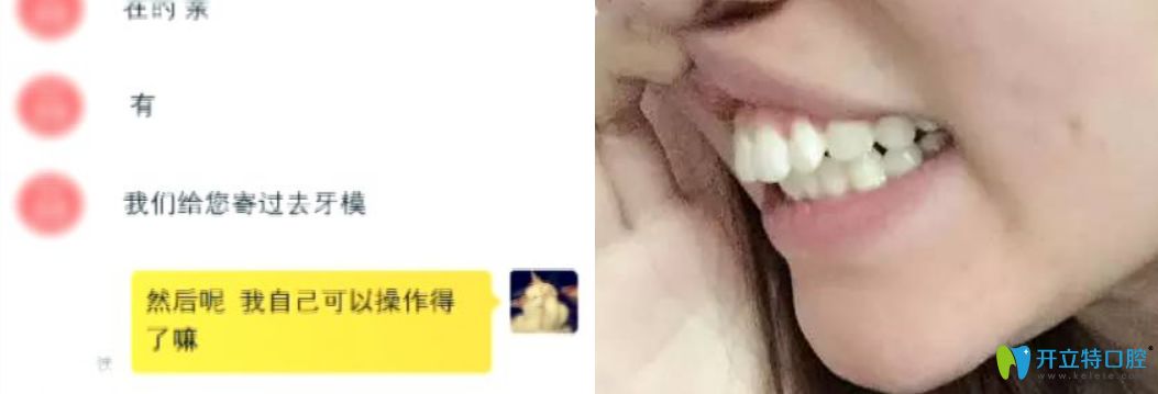 90后姑娘網(wǎng)購隱形矯正器矯正牙齒真人案例