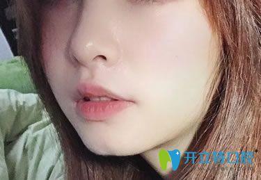 在<!--<i data=20240703-sp></i>--><!--<i data=20240703-sp></i>-->口腔做完骨性齙牙矯正2年后的變化 在<!--<i data=20240703-sp></i>--><!--<i data=20240703-sp></i>-->口腔做完骨性齙牙矯正2年后的變化