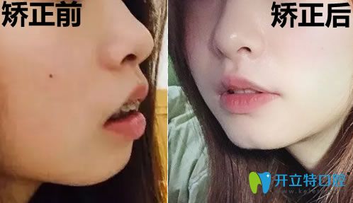 骨性齙牙拔了四顆牙臉型變化對比圖 骨性齙牙拔了四顆牙臉型變化對比圖