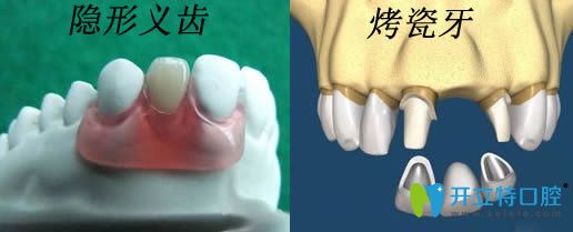 隱形義齒和烤瓷牙安裝示意圖