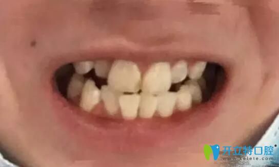 去北京南區(qū)口腔做牙齒二次矯正前樣子 去北京南區(qū)口腔做牙齒二次矯正前樣子