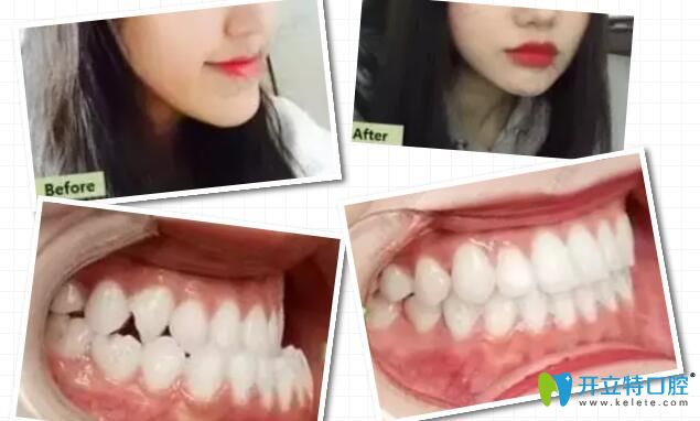 陳占美地包天矯正案例