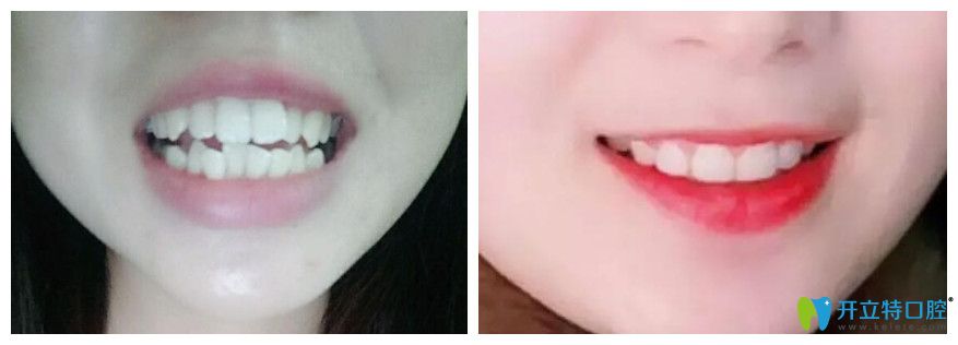 馬婧倩真人正畸案例效果圖