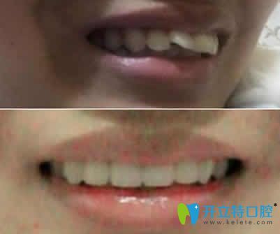 牙齒矯正前后對比圖