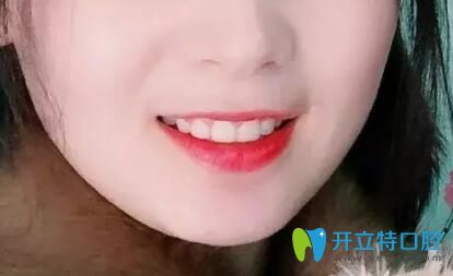 北京南區(qū)口腔牙齒矯正摘掉牙套后照片 北京南區(qū)口腔牙齒矯正摘掉牙套后照片