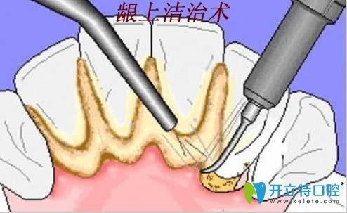 齦上潔治術(shù)治療過程圖
