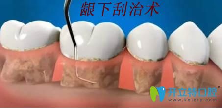 齦下刮治術(shù)操作過程示意圖