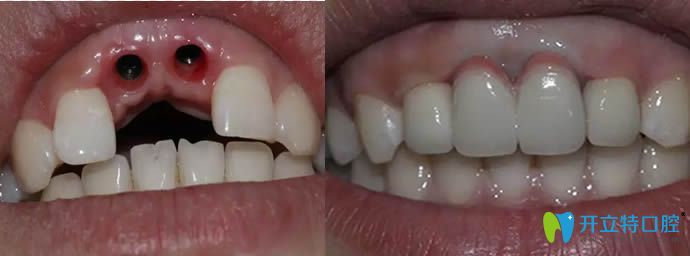 <!--<i data=20240703-sp></i>-->恒愿齒科侯睿種植牙前后效果對比圖 <!--<i data=20240703-sp></i>-->恒愿齒科侯睿種植牙前后效果對比圖