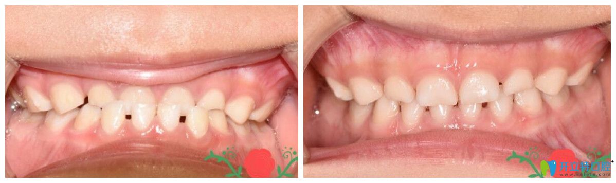 孩子地包天矯正效果怎么樣？來(lái)看一下真實(shí)案例吧