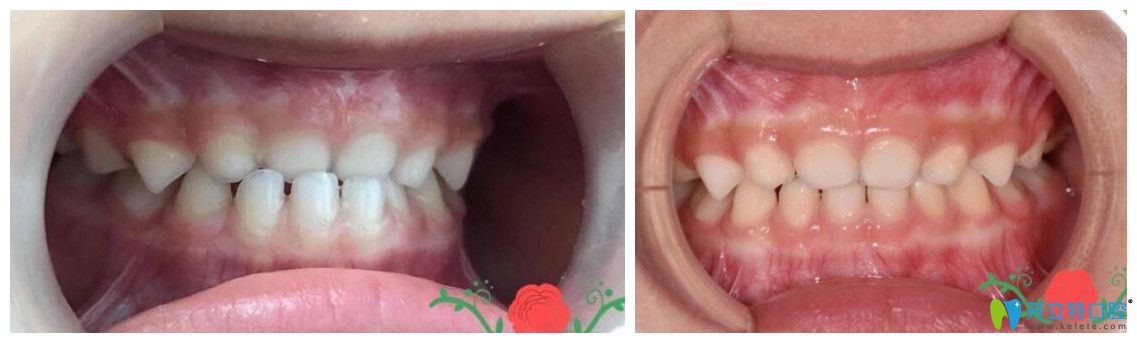 3歲的小女孩地包天矯正案例對(duì)比圖