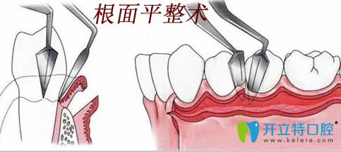 牙周治療之根面平整術(shù)操作過程圖