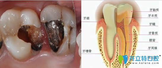 什么情況需要根管治療?蘇州錦城口腔深度解析根管治療術(shù)
