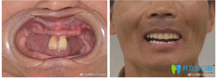 黃懽醫(yī)生全口種植牙前后效果圖