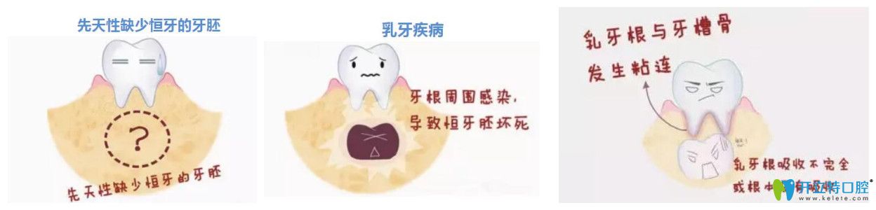 孩子為什么會(huì)出現(xiàn)乳牙滯留的原因