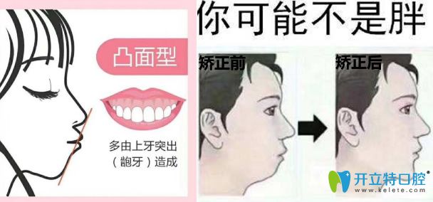 揭秘嘴突矯正后悔一輩子的真相,證明帶牙套是能改善凸嘴的