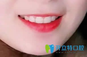 我在西安優(yōu)德口腔做牙齒矯正15個月效果