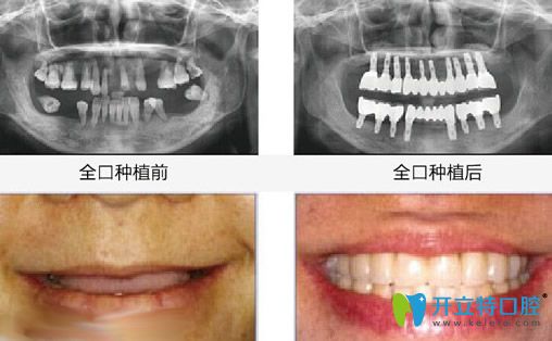 昆明竹子口腔<!--<i data=20240703-sp></i>-->國(guó)醫(yī)生全口種植牙案例效果