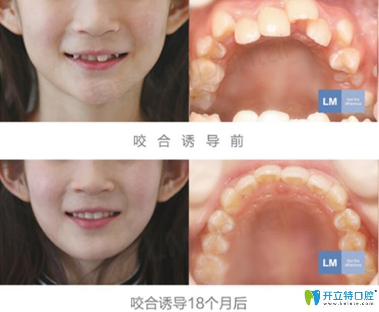 <!--<i data=20240703-sp></i>-->兒童口腔好不好？來看兒童羅慕誘導(dǎo)矯正案例