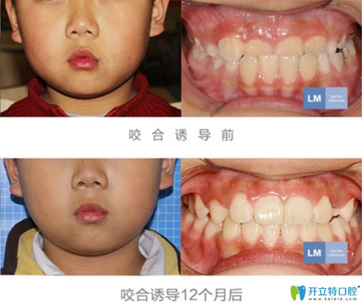 男孩在<!--<i data=20240703-sp></i>-->兒童口腔做落幕咬合誘導(dǎo)矯正案例對比圖