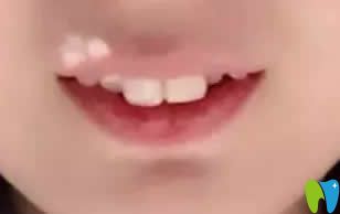 我在西安優(yōu)德口腔戴牙套第2個月