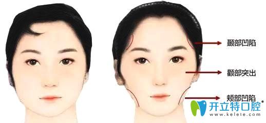 牙齒矯正中牙套臉是怎么形成的？什么臉型容易出現(xiàn)牙套臉