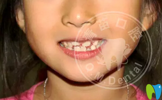 <!--<i data=20240703-sp></i>-->兒童口腔羅慕誘導(dǎo)矯正牙齒反頜案例