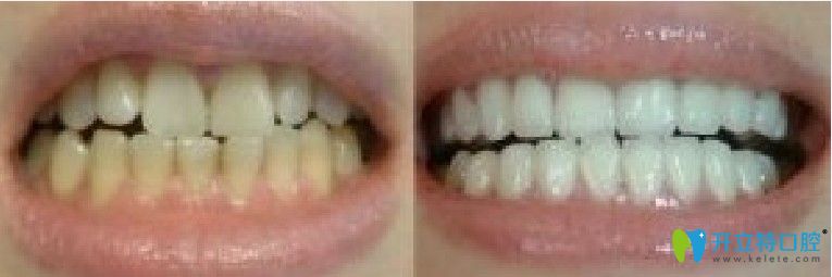 竹子口腔牙齒冷光美白前后對(duì)比圖