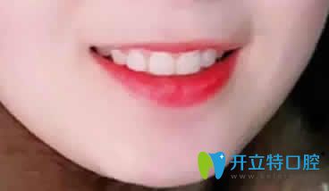 我在昆明竹子口腔做隱形矯正一年的效果