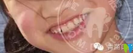 兒童露齦笑咬合誘導(dǎo)矯正案例效果圖