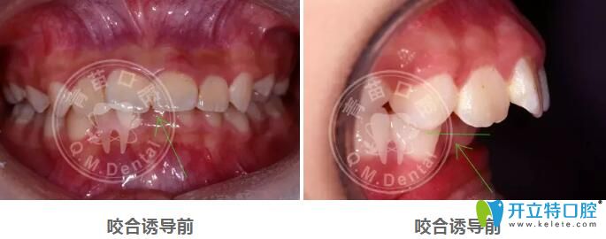 兒童咬合誘導(dǎo)哪家好？深圳青苗口腔羅慕咬合矯正案例驗(yàn)證