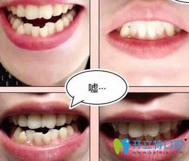 給你瞅瞅我在昆明竹子口腔做的不拔牙隱形矯正效果怎么樣