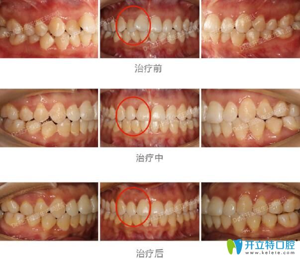 茁悅口腔陸開盛牙齒不齊矯正案例過程圖
