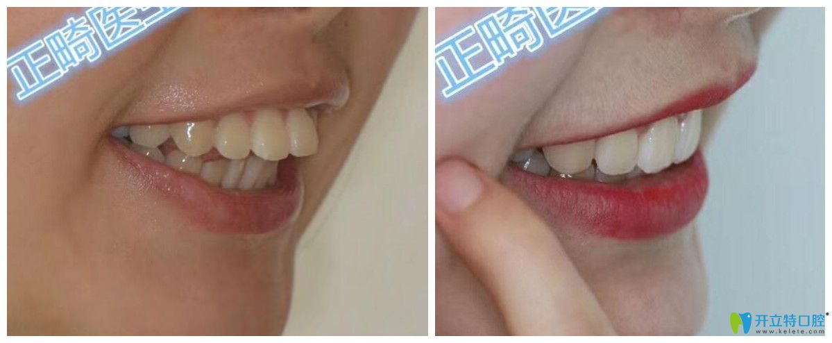 找重慶茁悅口腔李書琴做齙牙矯正案例