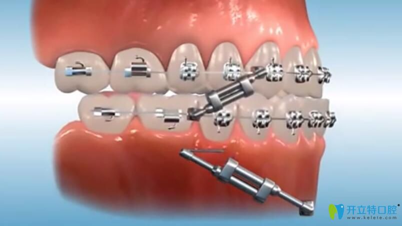 托槽矯正中醫(yī)生在后期是如何調(diào)整咬合關(guān)系的
