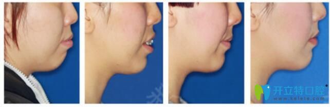 重慶茁悅口腔好不好？真人案例效果見證奇跡