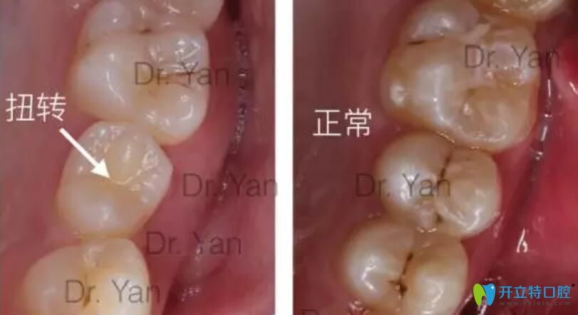 牙齒咬合關(guān)系對比圖