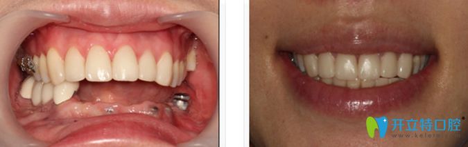 廣州圣貝口腔多顆牙種植效果