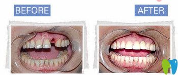 種植牙前后對(duì)比照
