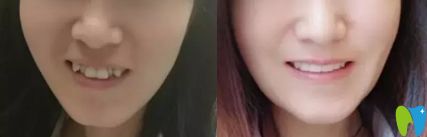 廣州圣貝隱形牙齒矯正前后對(duì)比圖