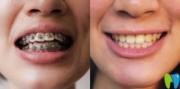 吳勇牙齒正畸案例效果對(duì)比圖 吳勇牙齒正畸案例效果對(duì)比圖