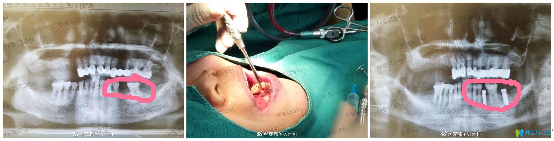 圣貝口腔種牙怎么樣？案例效果來驗(yàn)證