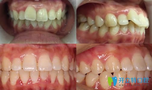 <!--<i data=20240703-sp></i>-->恒愿齒科黃曉莉牙齒矯正案例效果對比圖 <!--<i data=20240703-sp></i>-->恒愿齒科黃曉莉牙齒矯正案例效果對比圖