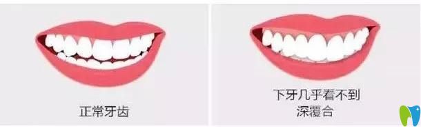 正常牙和深覆合牙齒圖片